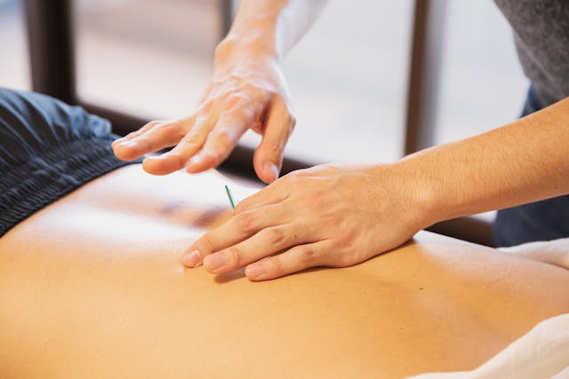 an individual getting acupuncture on their back